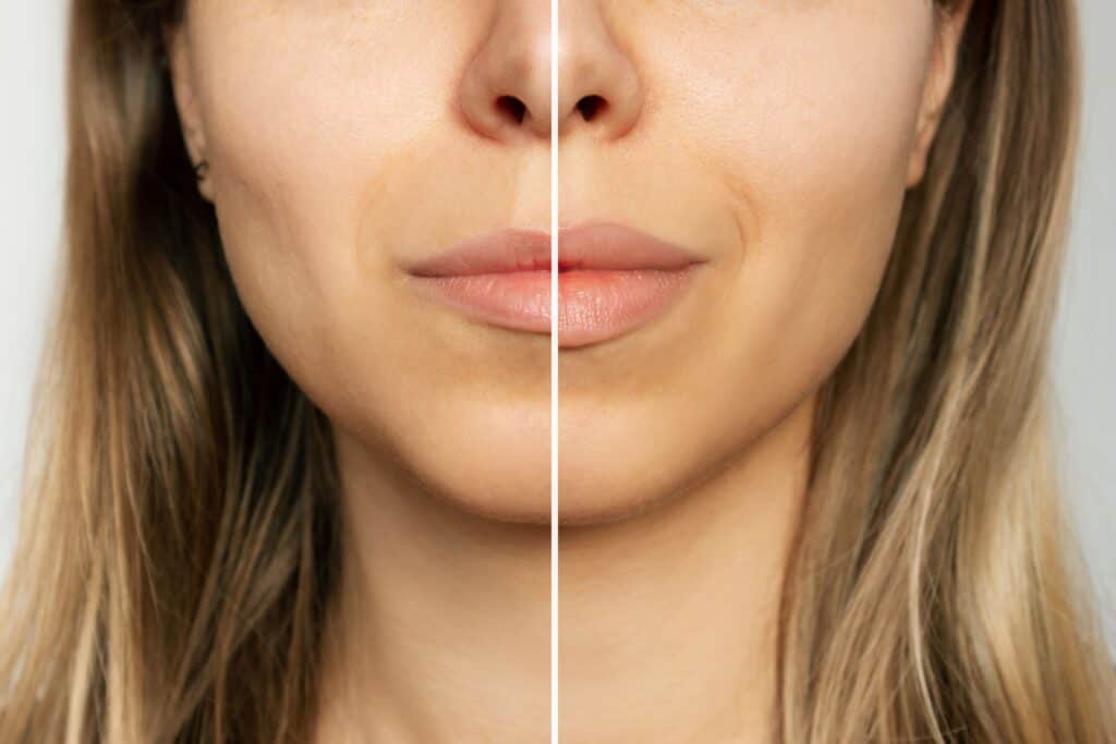 Before & After Versa Lip Filler Treatments | Evolution Health and Wellness in Port Orange, FL