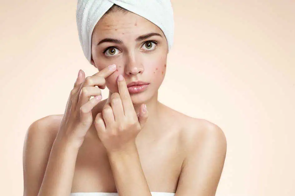 Teen Acne Treatment by Evolution Health and Wellness in Port Orange, FL