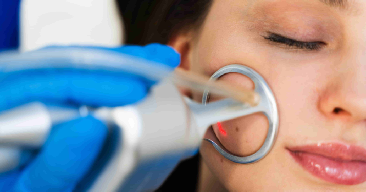 woman receiving a laser resurfacing facial treatment on her cheek by a professional wearing blue gloves in Port Orange, FL