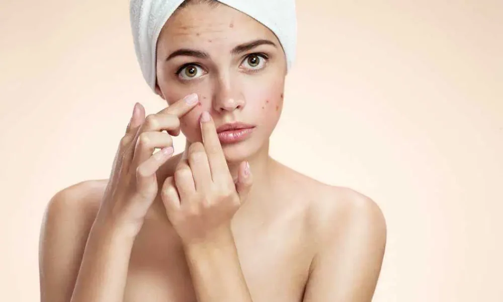 Teen Acne Treatment by Evolution Health and Wellness in Port Orange, FL