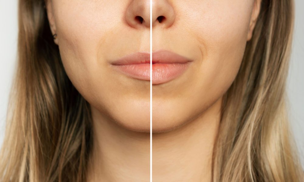 Before & After Versa Lip Filler Treatments | Evolution Health and Wellness in Port Orange, FL