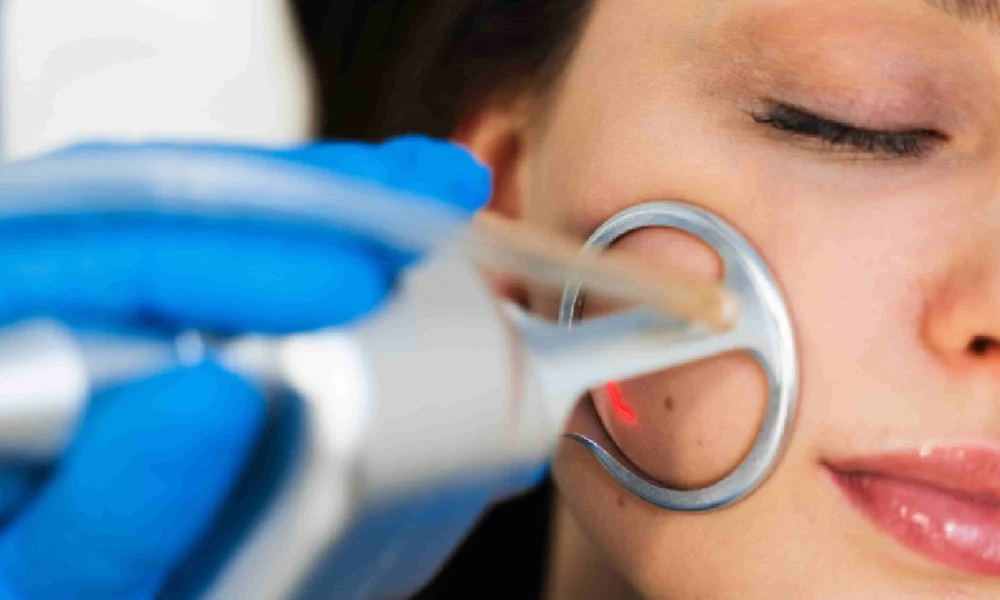 woman receiving a laser resurfacing facial treatment on her cheek by a professional wearing blue gloves in Port Orange, FL
