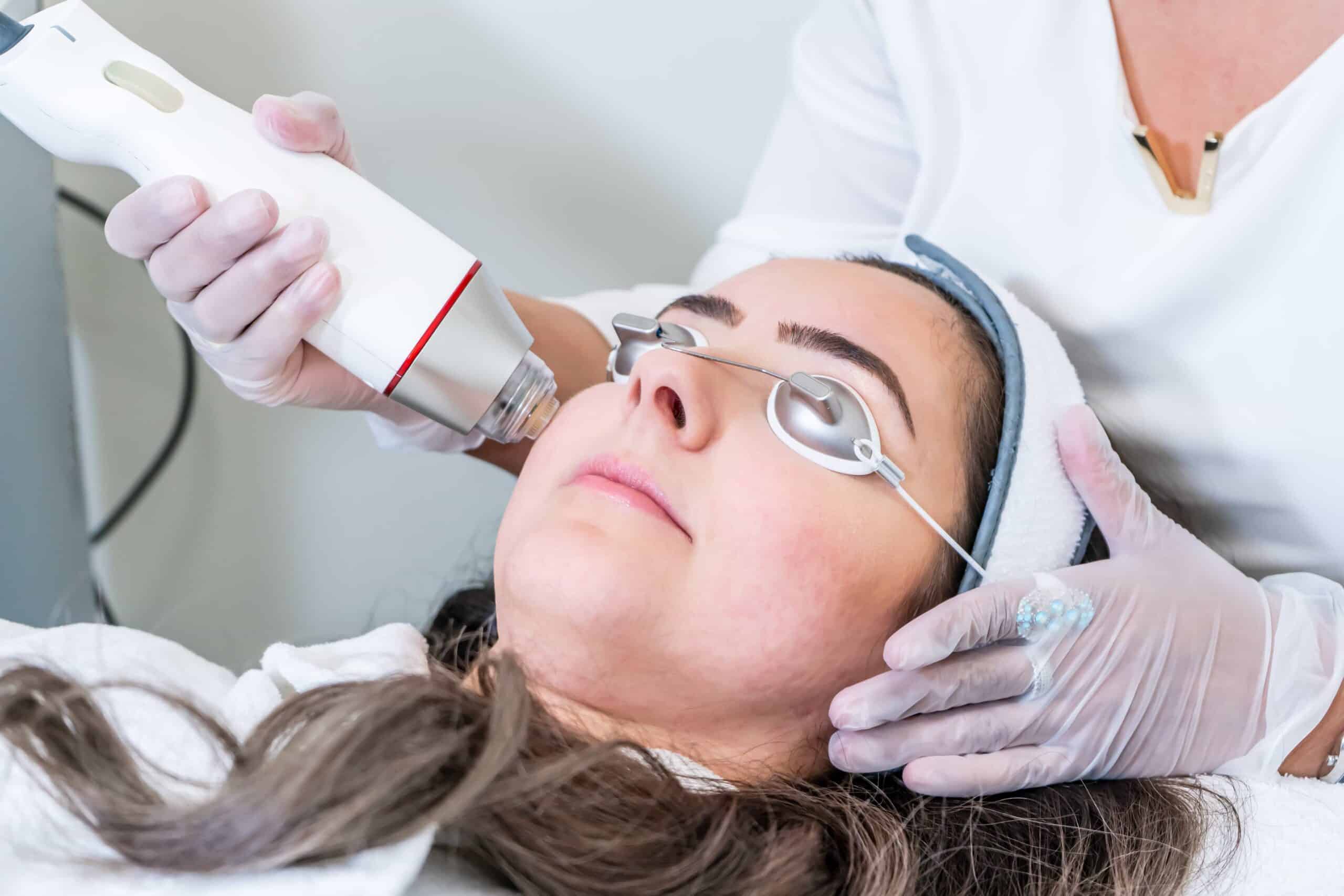 What Are The Benefits Of Radiofrequency Microneedling?